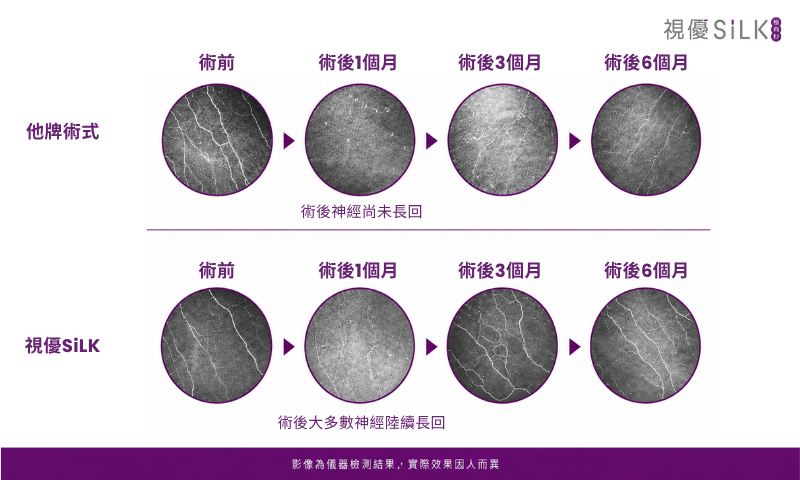 視優SiLK近視雷射術後乾眼風險低的原因